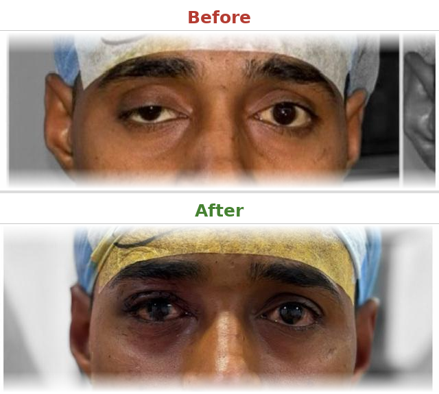 Ptosis correction - Before and After