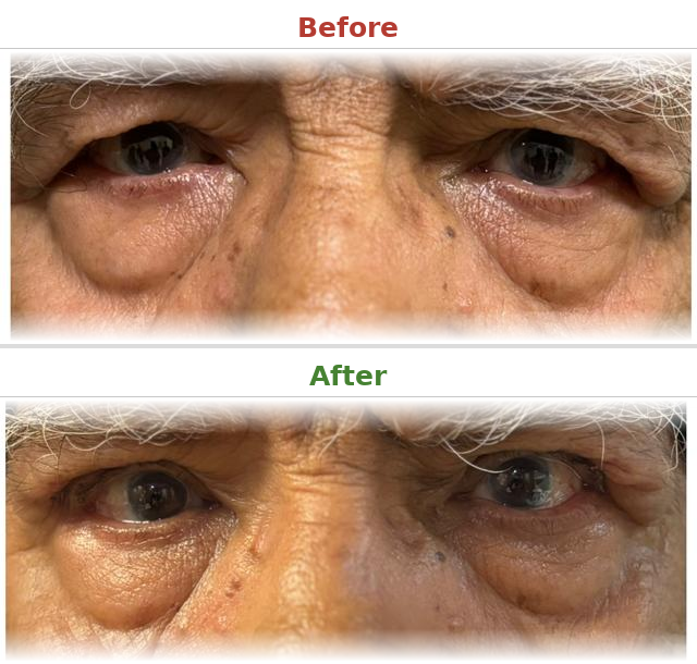 Entropion correction - Before and After