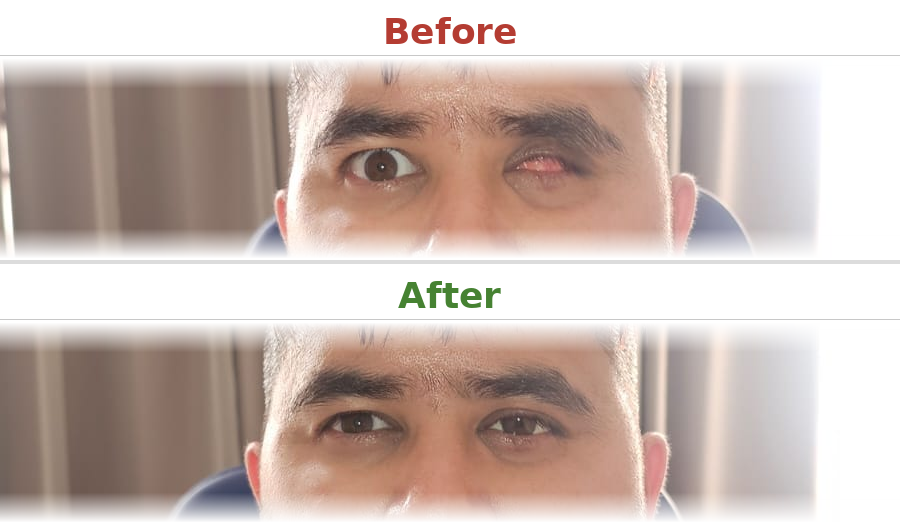 Ocular prosthesis - Before and After