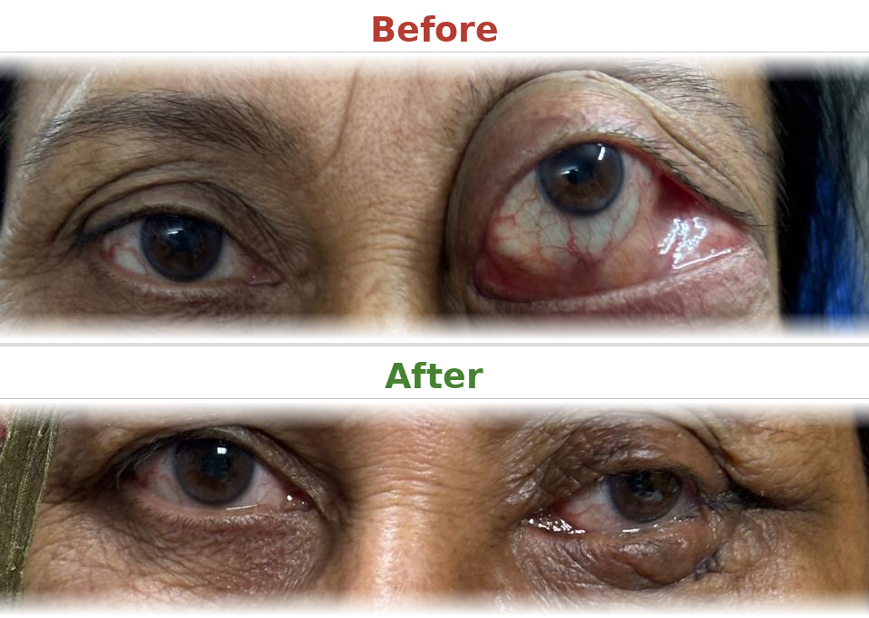 Orbital mass excision - Before and After