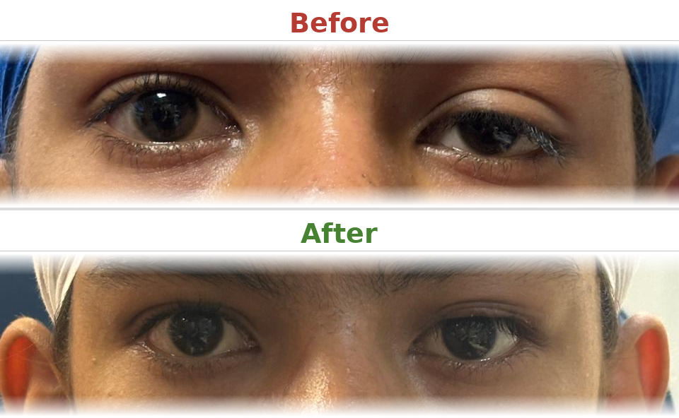 Ptosis correction - Before and After