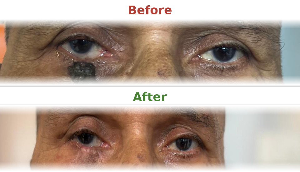 Lid mass excision and reconstruction - Before and After