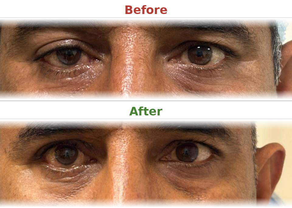 Ptosis correction - Before and After