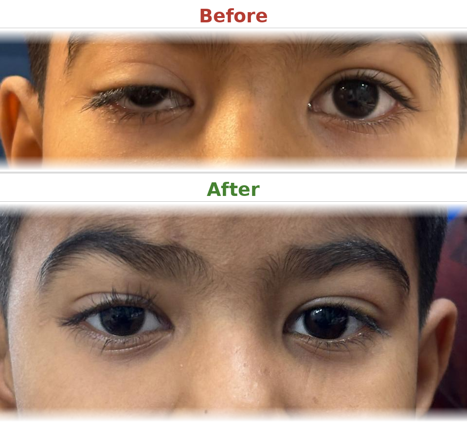 Ptosis correction (pediatric) - Before and After
